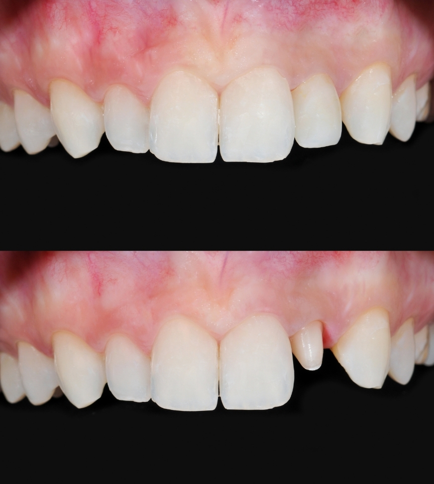 dental crown before and after